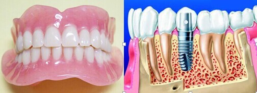 种植牙和传统假牙哪个更好？