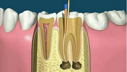 南京牙齿根管治疗步骤