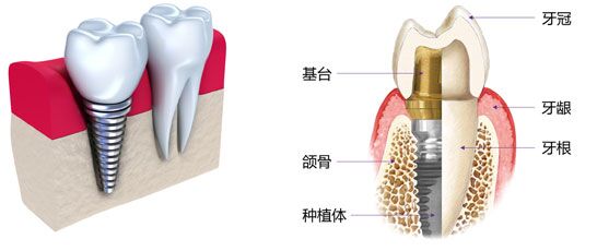 南京全口义齿多少钱？