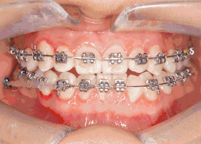 牙齿之间有缝隙怎么修补