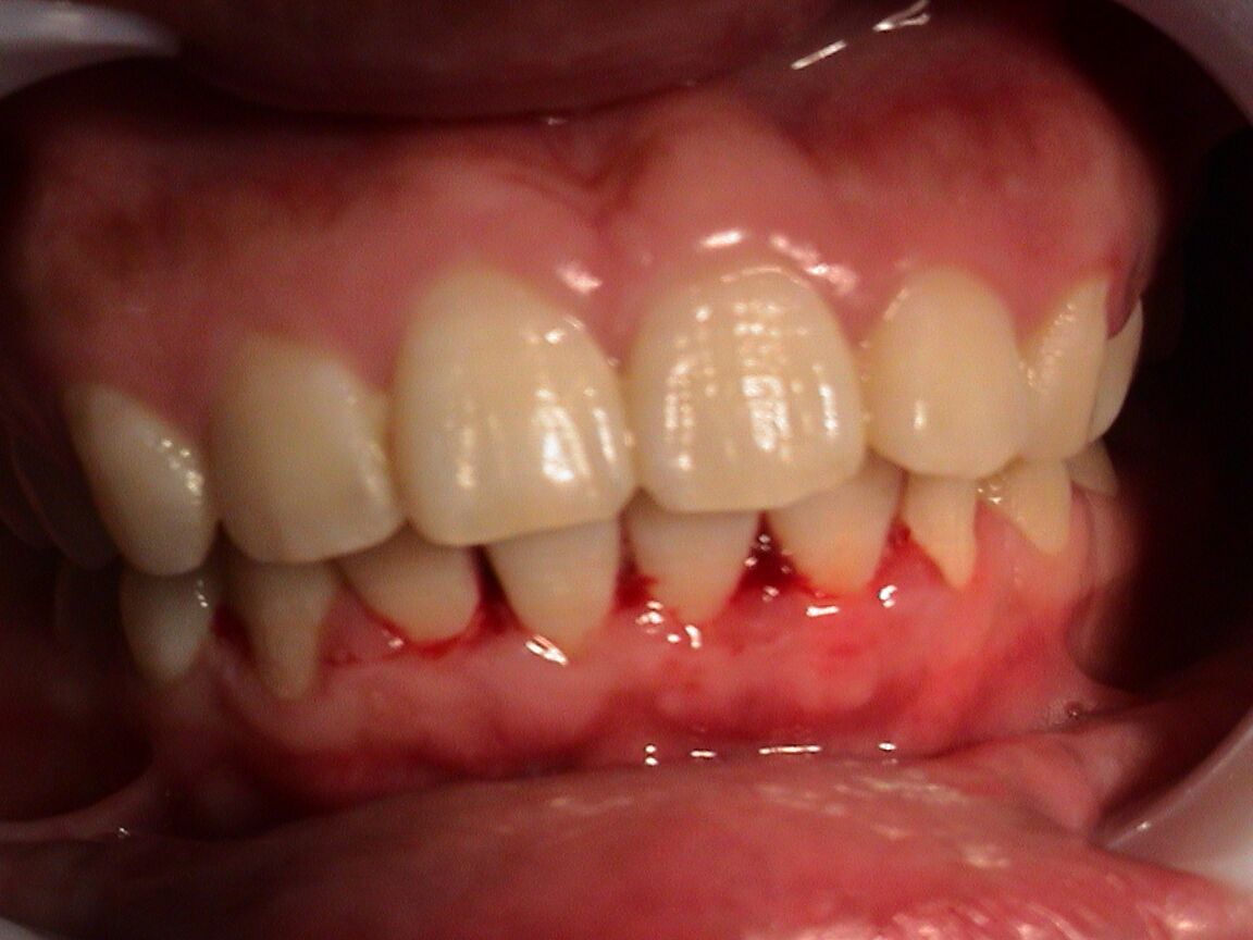 牙齿刷牙老出血是怎么回事？