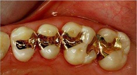 造成蛀牙的原因及治疗方法