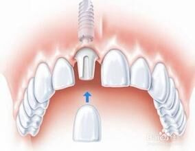 种植门牙的过程是怎样的？