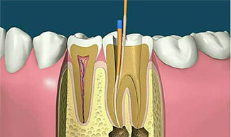 什么是根管治疗牙齿