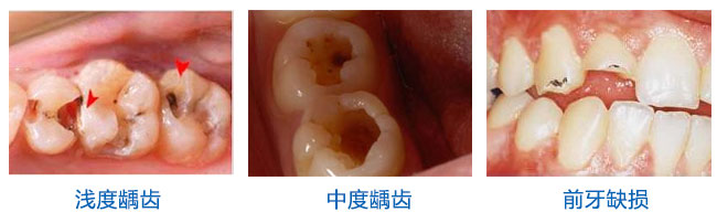 怎么确定蛀牙烂到了牙神经