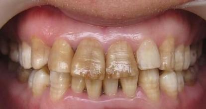 黄牙能洗白吗？