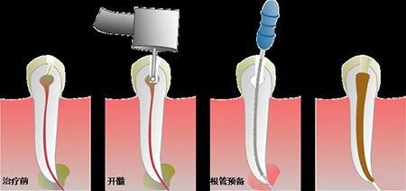 根管治疗之后牙疼的原因