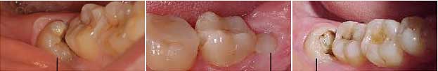智齿冠周炎一般要牙痛多久