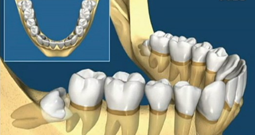 智齿冠周炎为什么会引起牙疼
