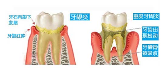 南京牙龈炎有哪些危害，该怎么治疗？